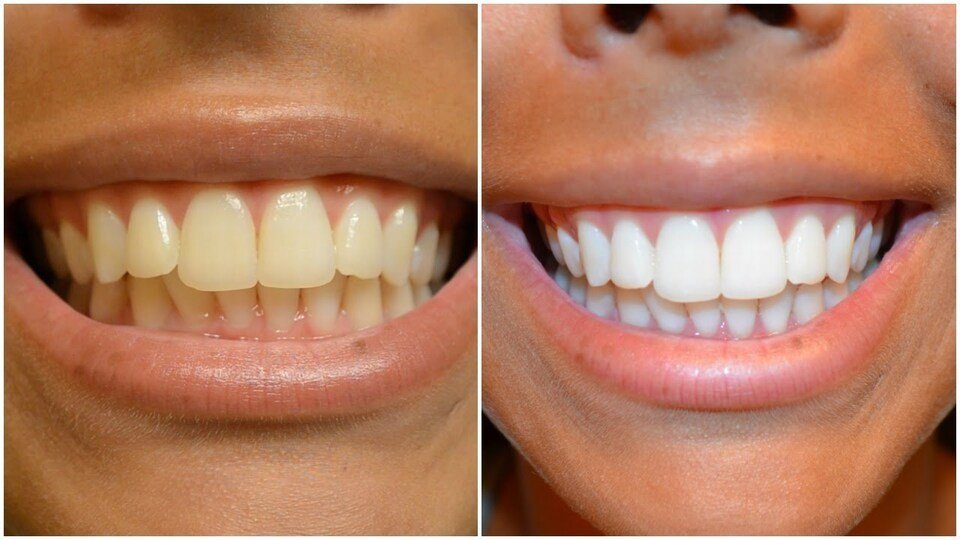 Why get teeth whitening: real benefits