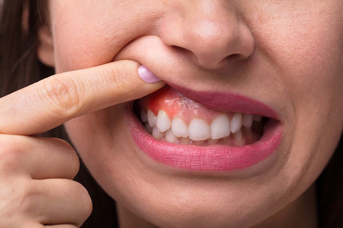 Why are my gums bleeding? Causes of gum bleeding and solutions